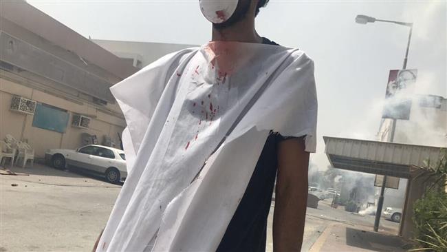 A picture posted on Twitter shows a protester injured during clashes with security forces in the northwestern Bahraini village of Diraz on May 23, 2017.
