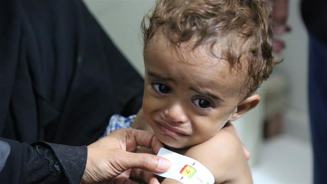 A three-year-old Yemeni child receiving treatment for moderate acute malnutrition in a hospital in Yemen’s Hajjah province. (Photos via WFP) 
