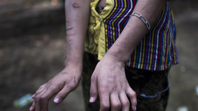 In this photo taken on September 20, 2016, San Kay Khine, a 17-year-old Myanmar child slave, shows her scarred arms and twisted fingers whilst recovering in her family’s village in Baw Lone Kwin, Kawhmu township located outside Yangon. (Photo by AFP)

