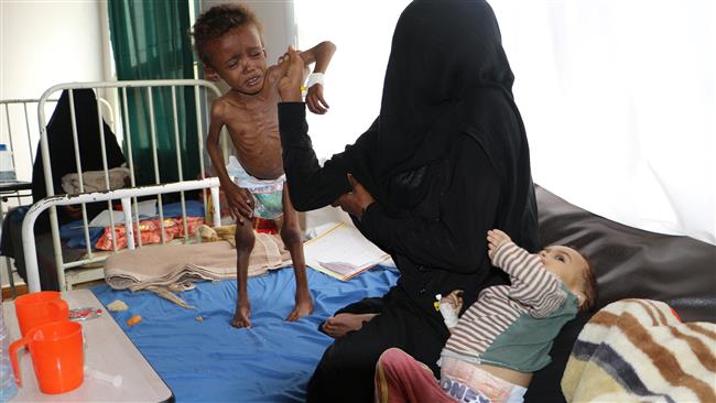 A Yemeni child, who suffers from malnutrition