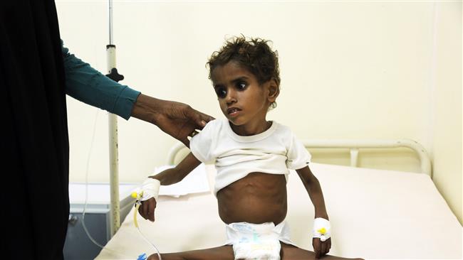 This photo taken on November 05, 2017 shows a malnourished Yemeni child receiving treatment at a hospital in the Yemeni port city of Hudaydah. (Photo by AFP)
