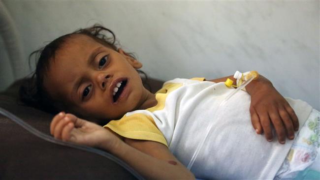 A malnourished Yemeni child receives treatment at a hospital in the Yemeni coastal city of Hudaydah on November 11, 2017. (Photo by AFP)
