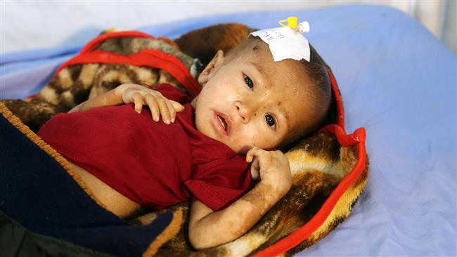 A malnourished Yemeni child receives treatment at a hospital in the Yemeni port city of Hudaydah on January 16, 2018. (Photo by AFP)
