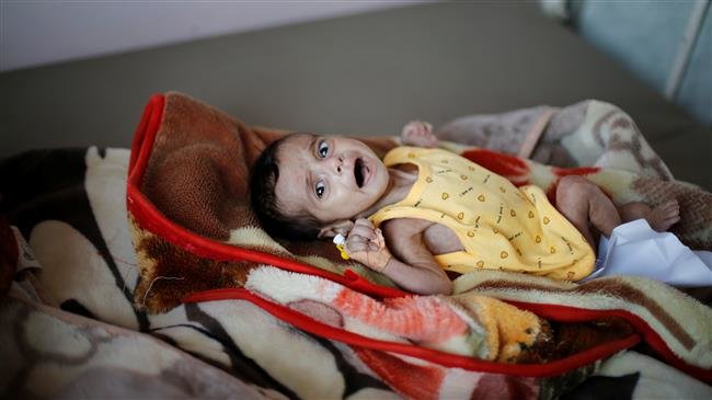 A malnourished child cries at al-Sabeen hospital in Sana
