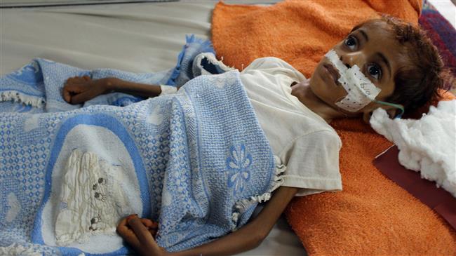 In this picture taken on September 8, 2018, a Yemeni child suffering from malnutrition receives treatment at a hospital in the northern district of Abs, in Yemen
