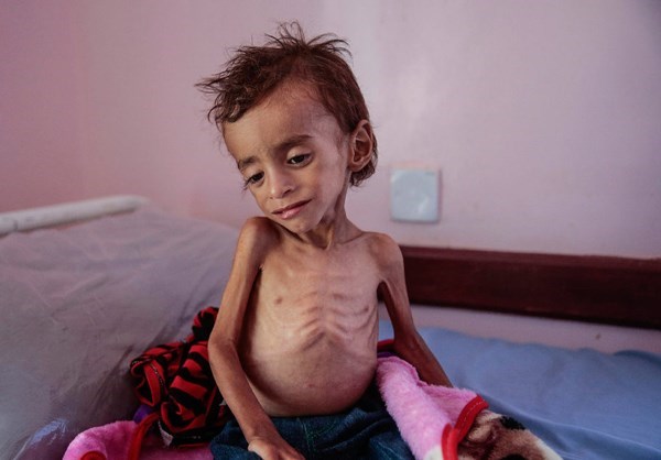 Yemenis on Brink of Famine 