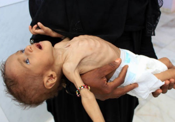 Yemeni Malnourished Children 
