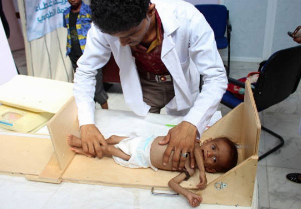 Yemeni Malnourished Children 