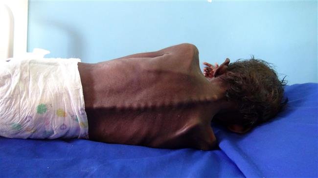 This picture, taken on November 22, 2018, shows a five-year-old Yemeni boy suffering from severe malnutrition on a bed at a treatment clinic in Khokha district in the western province of Hudaydah, Yemen. (Photo by AFP)
