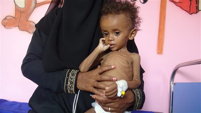 A Yemeni mother holds her malnourished child as they wait for treatment in a medical center in the village of al-Mutaynah, in Hudaydah province, Yemen. The AFP file photo was taken on November 29, 2018.
