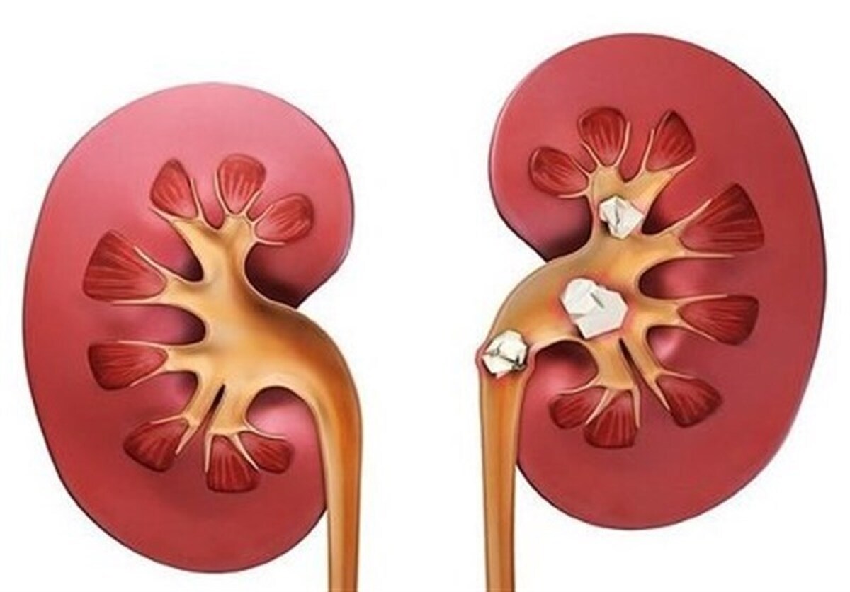 ایران روی کمربند سنگ کلیه قرار دارد/ توصیه‌ای به مردان بالای ۵۰ سال