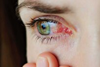 کدام شغل‌ها باعث خشکی چشم می‌شوند؟